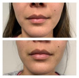 PlumpRFBeforeAfter