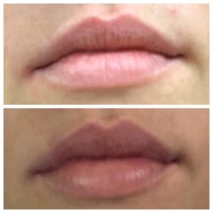 PlumpRFBeforeAfter2