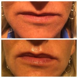 PlumpRFBeforeAfter3