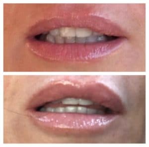 PlumpRFBeforeAfter4