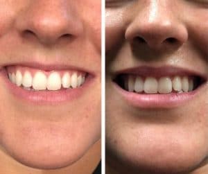 PlumpRFBeforeAfter5