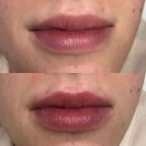 PlumpRFBeforeAfter6