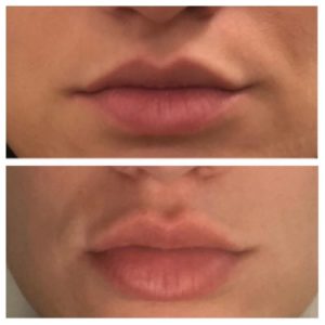 PlumpRFBeforeAfter7