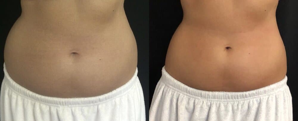 abdomenbodycontour