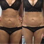 bellybeforeafter