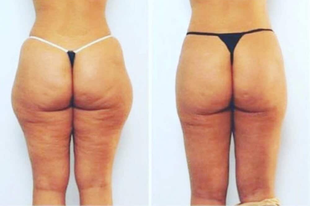 butt2
