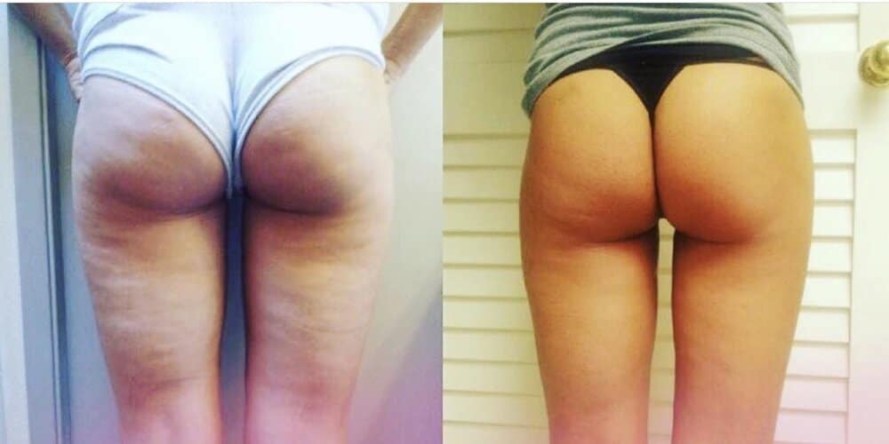 buttbeforeafter