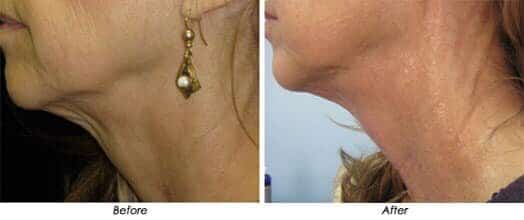 skin tightening before after
