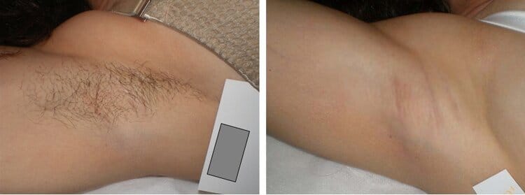 beforeafter