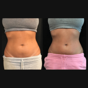 Body Contouring