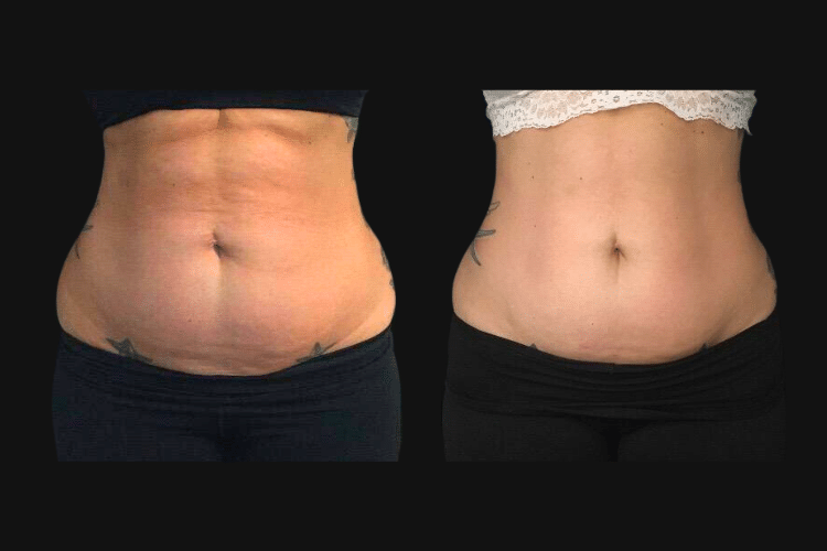 Body Contouring